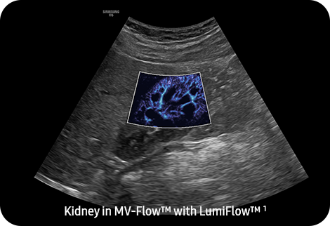 Kidney in MV-Flow™ with LumiFlow™ ¹