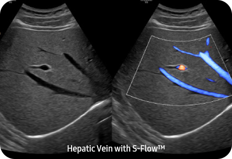 Hepatic Vein with S-Flow™