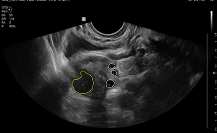 ob gyn ultrasound : 2D Follicle™