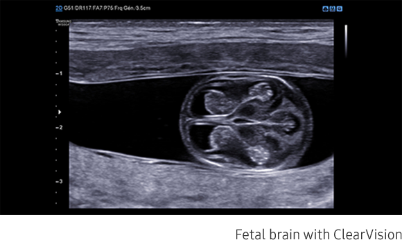 Fetal brain with ClearVision