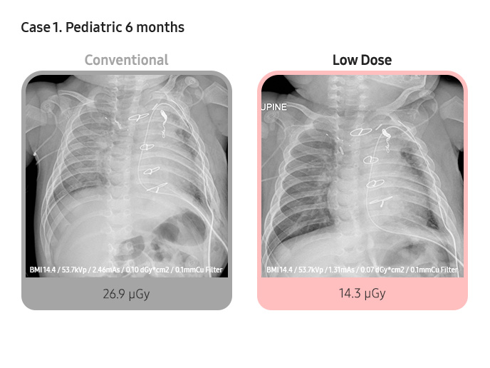 Case 1. Pediatric 6 months
