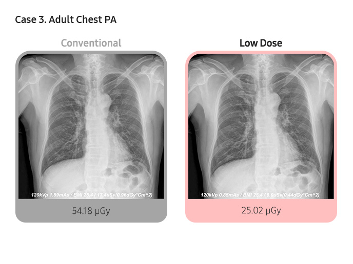 Case 3. Adult Chest PA