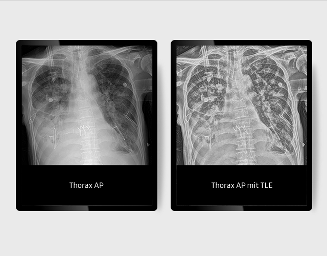 Zwei Röntgenaufnahmen: Links ohne TLE (Tube & Line Enhancement) und rechts mit TLE (Tube Enhancement) Funktion von Samsung