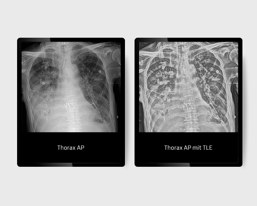 Zwei Röntgenaufnahmen: Links ohne TLE (Tube & Line Enhancement) und rechts mit TLE (Tube Enhancement) Funktion von Samsung