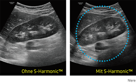 Ultraschallbild Niere links ohne S-Harmonic und rechts mit S-Harmonic.