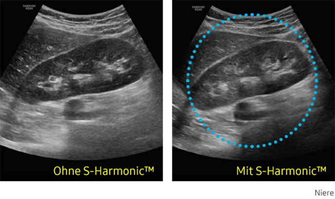 Ultraschallbild Niere links ohne S-Harmonic und rechts mit S-Harmonic.
