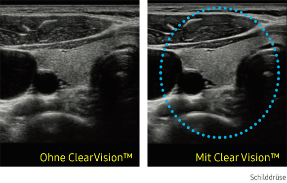 Ultraschallbild Schilddrüse links ohne ClearVision und rechts mit ClearVision von Samsung.