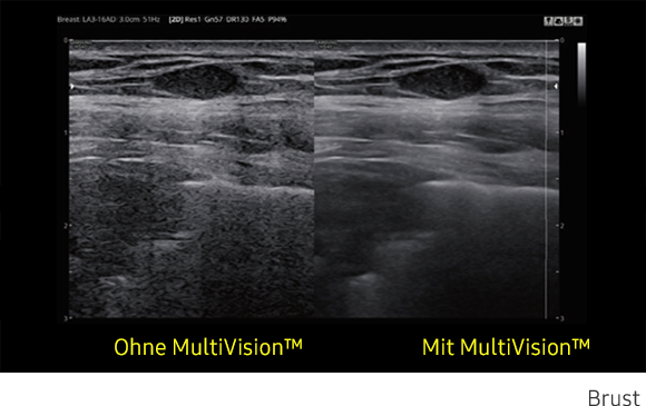Ultraschallbild Brust links ohne MultiVision und rechts mit MultiVision von Samsung.