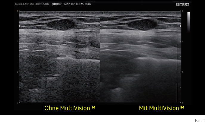 Ultraschallbild Brust links ohne MultiVision und rechts mit MultiVision von Samsung.