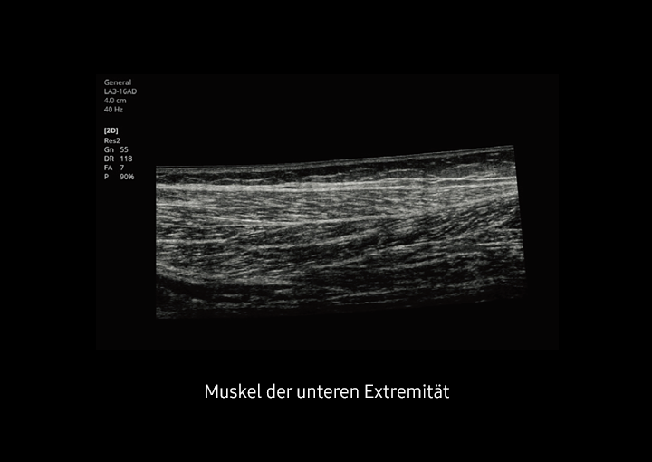 Ultraschallbild Muskel mit Panoramic Imaging mit Ultraschallsystem HS40 von Samsung