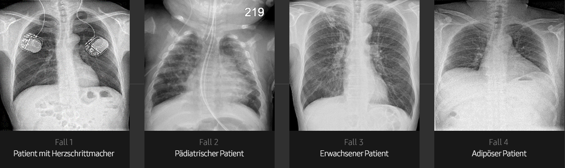 Röntgenbilder von der Brust (Patient mit Herzschrittmacher, pädiatrischer Patient, erwachsener Patient, adipöser Patient) aufgenommen mit digitalem Röntgensystem von Samsung