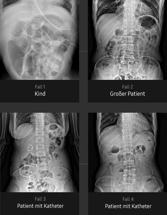 Röntgenbilder von Abdomen (Kind, großer Patient, Patient mit Katheter) aufgenommen mit digitalem Röntgengerät von Samsung