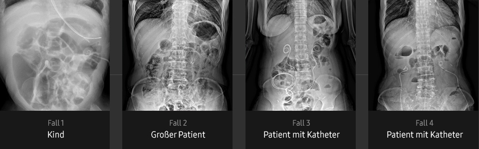 Röntgenbilder von Abdomen (Kind, großer Patient, Patient mit Katheter) aufgenommen mit digitalem Röntgengerät von Samsung
