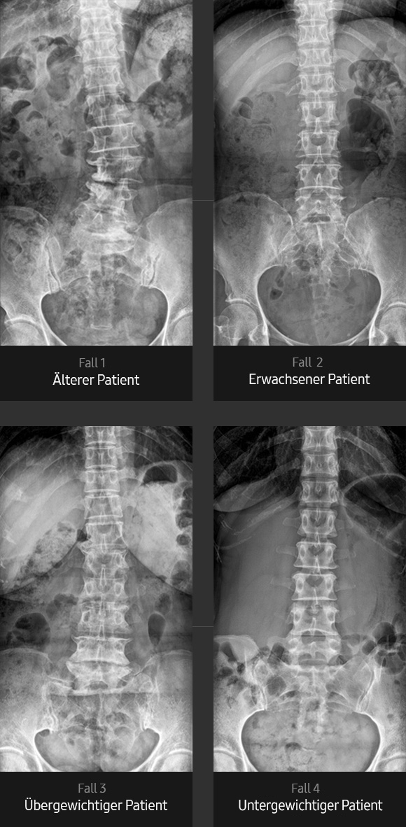 Röntgenbilder von Lendenwirbelsäule AP (älterer Patient, erwachsener Patient, übergewichtiger Patient, dünner Patient) aufgenommen mit digitalem Röntgengerät von Samsung