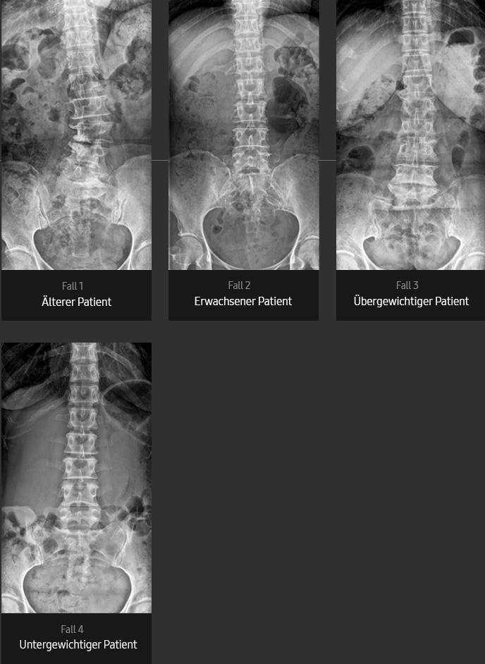 Röntgenbilder von Lendenwirbelsäule AP (älterer Patient, erwachsener Patient, übergewichtiger Patient, dünner Patient) aufgenommen mit digitalem Röntgengerät von Samsung