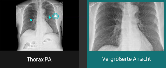 Röntgenbilder (Thorax, Thorax PA vergrößerte Ansicht) aufgenommen mit digitalem Röntgengerät von Samsung