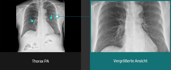 Röntgenbilder (Thorax, Thorax PA vergrößerte Ansicht) aufgenommen mit digitalem Röntgengerät von Samsung