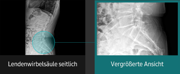 Röntgenbilder (Lendenwirbelsäule, Lendenwirbelsäule seitlich vergrößerte Ansicht) aufgenommen mit digitalem Röntgengerät von Samsung