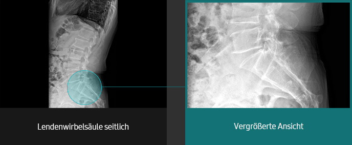 Röntgenbilder (Lendenwirbelsäule, Lendenwirbelsäule seitlich vergrößerte Ansicht) aufgenommen mit digitalem Röntgengerät von Samsung