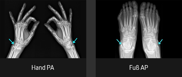 Röntgenbilder (überlagerte Fläche, Hand PA, Fuß AP) aufgenommen mit digitalem Röntgengerät von Samsung.