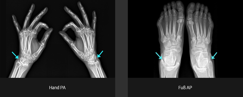 Röntgenbilder (überlagerte Fläche, Hand PA, Fuß AP) aufgenommen mit digitalem Röntgengerät von Samsung.