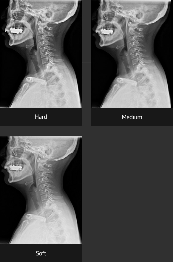 Röntgenbilder (Halswirbelsäule seitlich mit hartem, Medium und weichen Kontrast) aufgenommen mit digitalem Röntgensystem von Samsung.