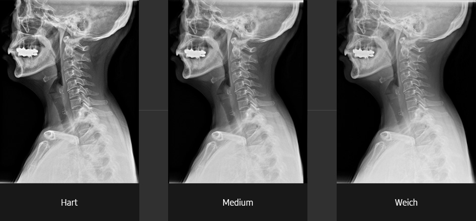 Röntgenbilder (Halswirbelsäule seitlich mit hartem, Medium und weichen Kontrast) aufgenommen mit digitalem Röntgensystem von Samsung.