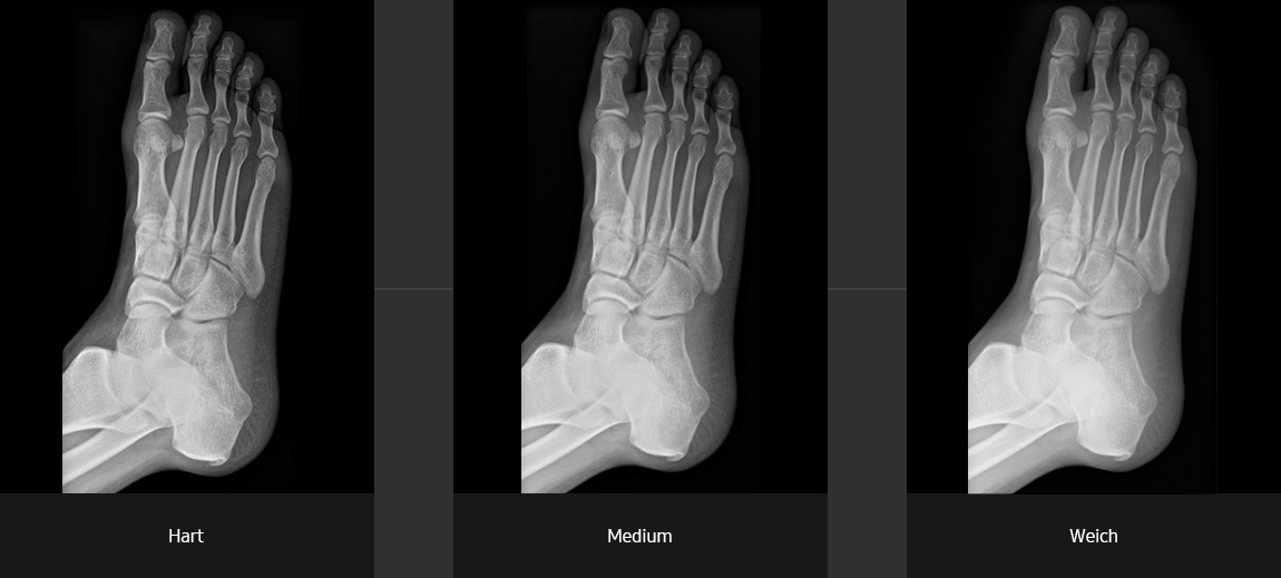 Röntgenaufnahmen (Fuß schräg mit hartem, medium und weichen Kontrast) aufgenommen mit digitalem Röntgensystem von Samsung.