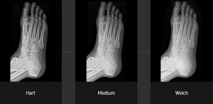 Röntgenaufnahmen (Fuß schräg mit hartem, medium und weichen Kontrast) aufgenommen mit digitalem Röntgensystem von Samsung.