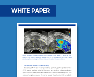 S-Shearwave Imaging™ para la predicción del cáncer de próstata