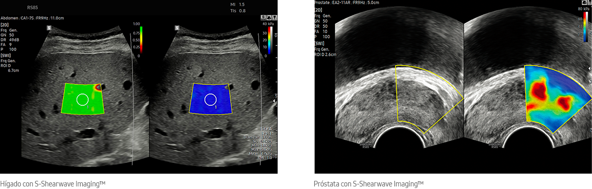 Hígado con S-Shearwave Imaging™, Próstata con S-Shearwave Imaging™