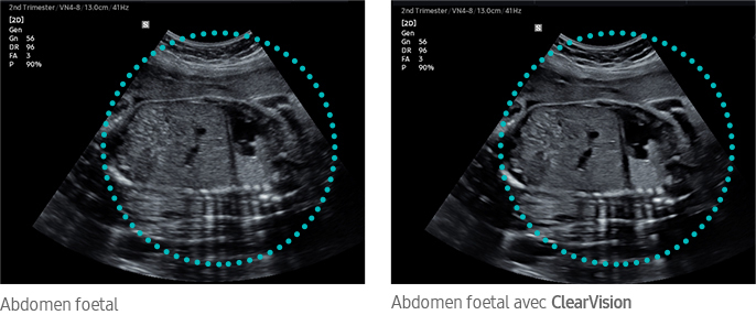 Abdomen foetal, Abdomen foetal avec ClearVision