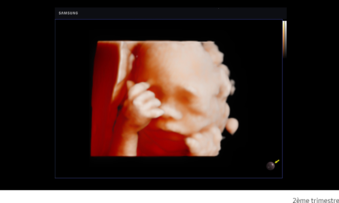 Samsung-HS40A-echographie-gynecologie-obstetrique-benefices-realistic-vue