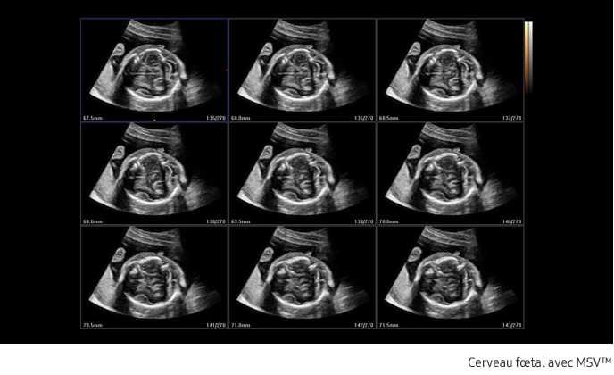 Samsung-HS40A-echographie-gynecologie-obstetrique-benefices-3dxi