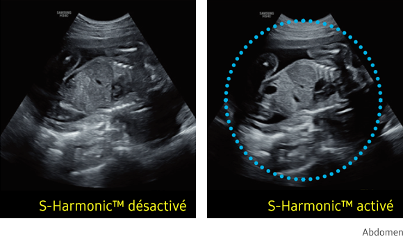 Samsung-HS40A-echographie-gynecologie-obstetrique-benefices-s-harmonic