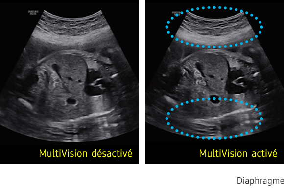 Samsung-HS40A-echographie-gynecologie-obstetrique-benefices-multivision
