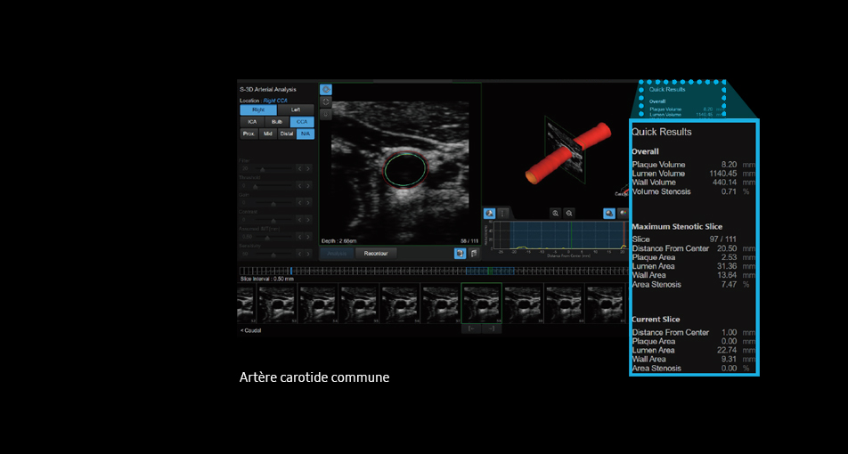 S-3D Arterial Analysis™