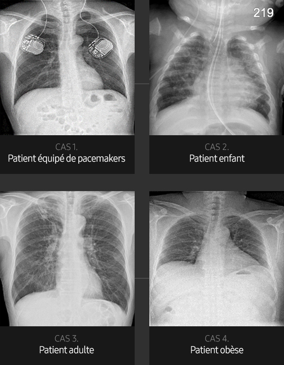 S-Vue-radiographie-benefices-qualite-image-thorax