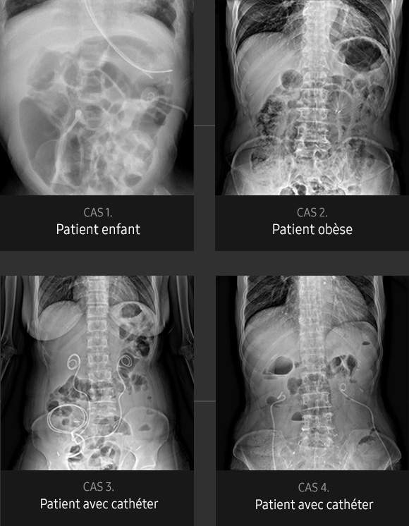 S-Vue-radiographie-benefices-qualite-image-abdomen