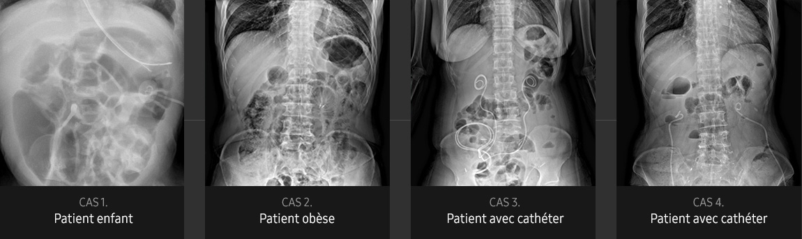 S-Vue-radiographie-benefices-qualite-image-abdomen