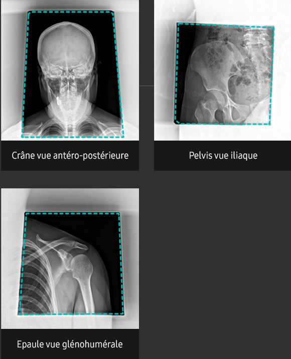 S-Vue-radiographie-benefices-qualite-image-diaphragme-automatique