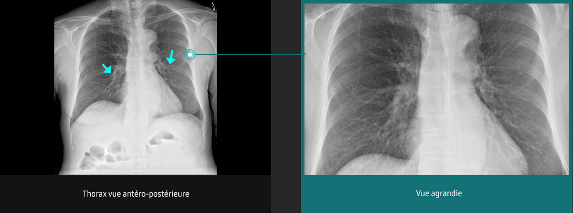 S-Vue-radiographie-benefices-amelioration-clarte-nettete-thorax