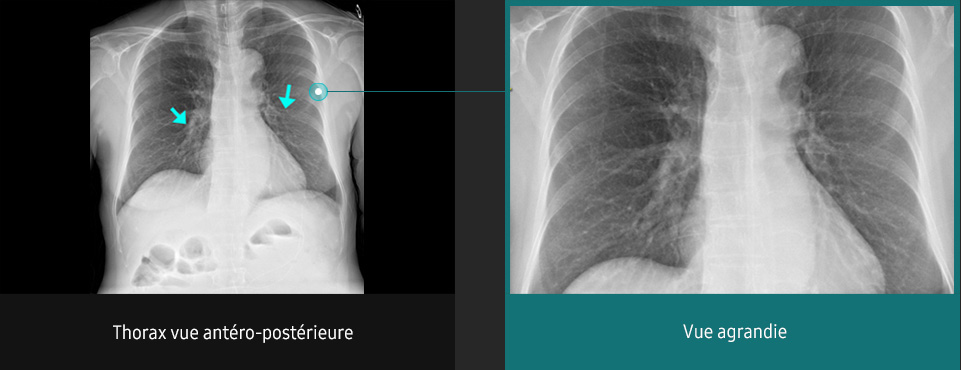 S-Vue-radiographie-benefices-amelioration-clarte-nettete-thorax