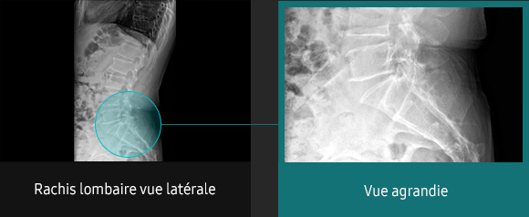 S-Vue-radiographie-benefices-amelioration-clarte-nettete-rachis-lombaire