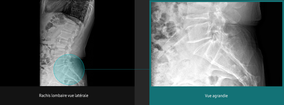S-Vue-radiographie-benefices-amelioration-clarte-nettete-rachis-lombaire
