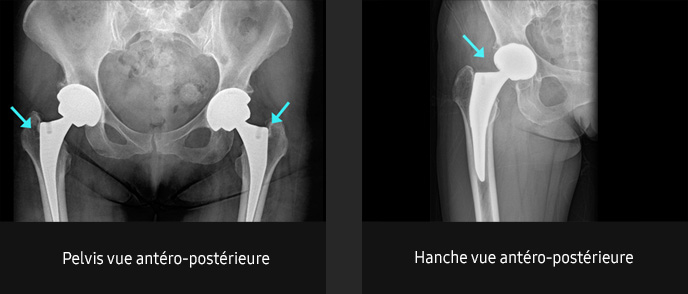 S-Vue-radiographie-benefices-amelioration-clarte-nettete-pelvis