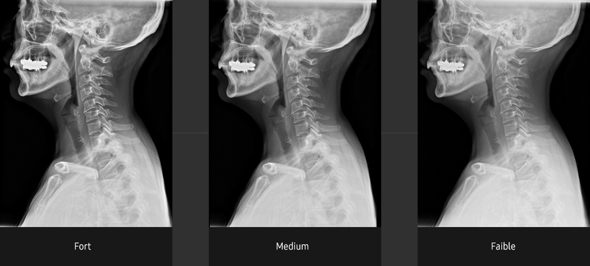 S-Vue-radiographie-benefices-ajustement-contraste-rachis-cervical