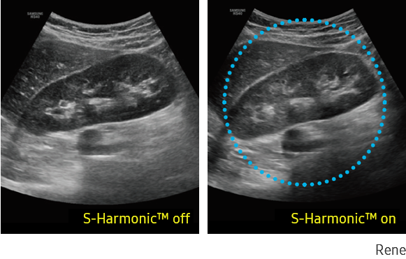 Immagine clinica del rene otenuta con S-Harmonic