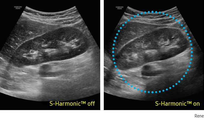 Immagine clinica del rene otenuta con S-Harmonic