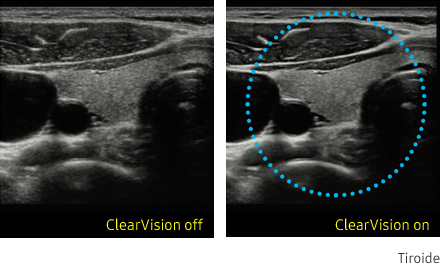 Immagine clinica della tiroide ottenuta con ClearVision